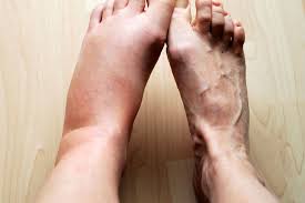 inflammation 03 inflammation 03